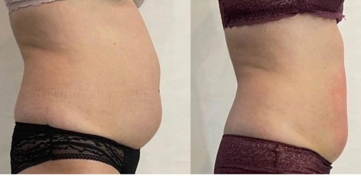 Liposuction in Islamabad – Achieve a Sleek, Toned Body