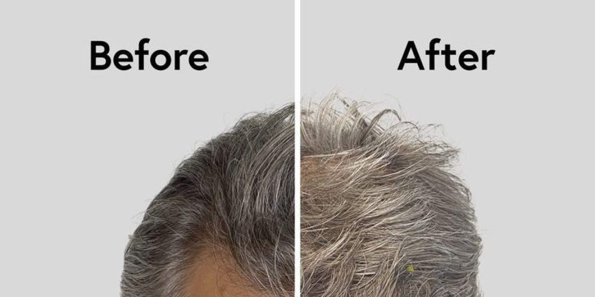 Permanent Hair Loss Treatment Options in Islamabad