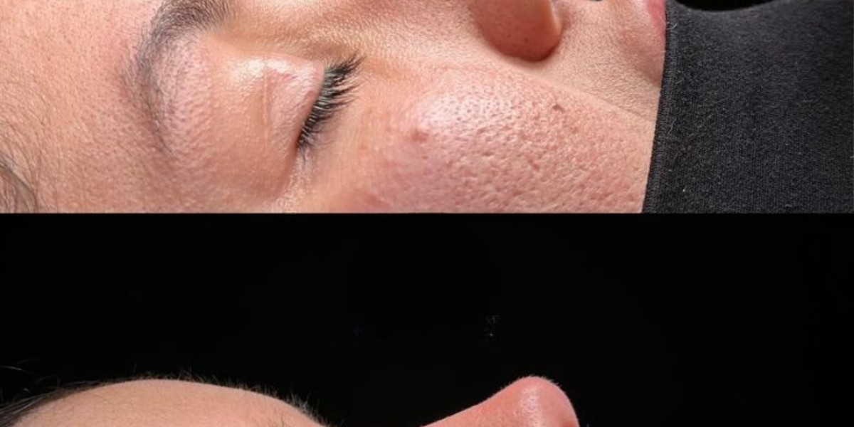 Enhance Your Facial Features with Rhinoplasty in Islamabad