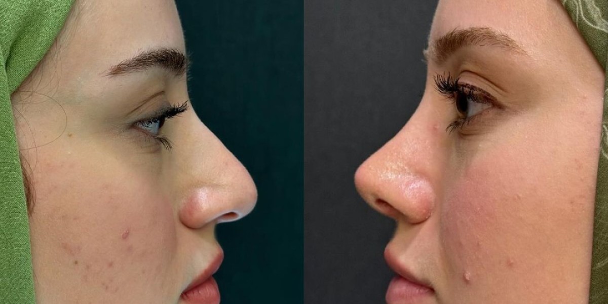 Rising Demand for Rhinoplasty in Islamabad