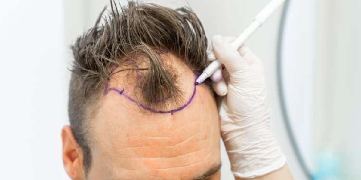 Hair Transplant in Islamabad: Types, Techniques, and Results