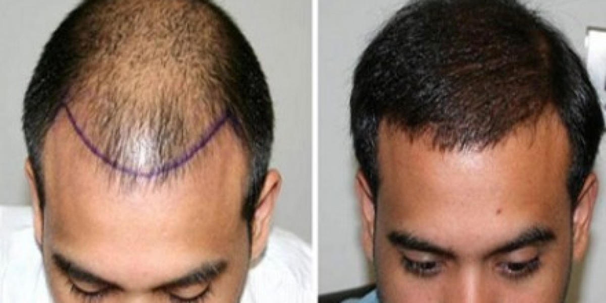 Hair transplantation in Riyadh: A long-term investment in your appearance and attractiveness
