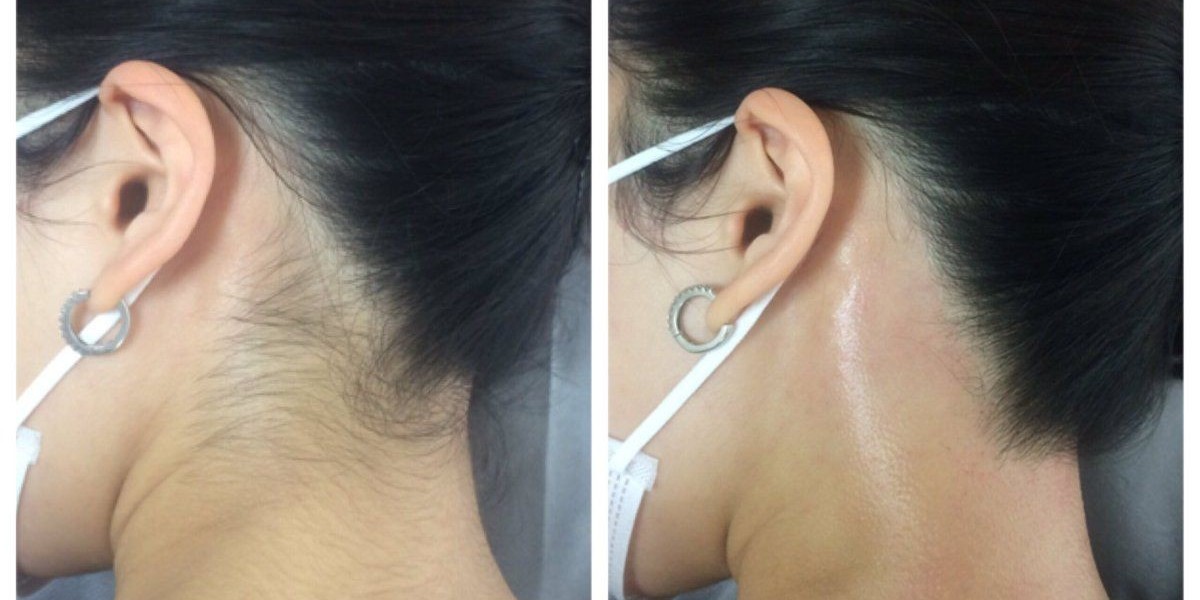 Laser Hair Removal in Islamabad: Advanced Care for Smooth, Clear Skin