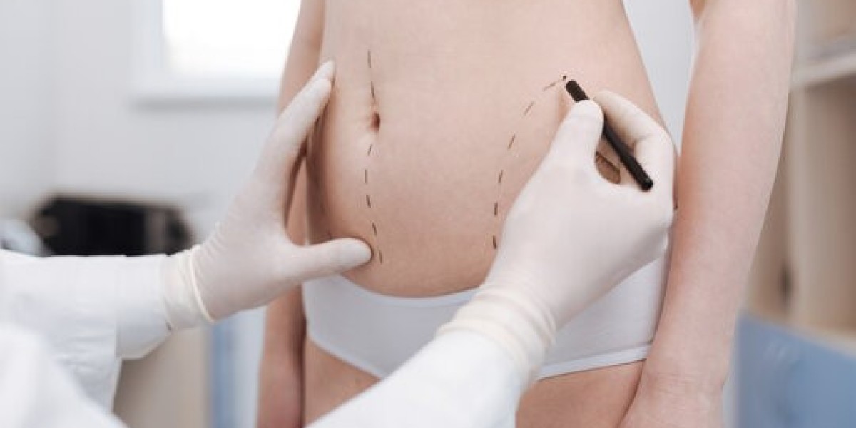 Choosing the Best Clinic for Liposuction Riyadh in 2026