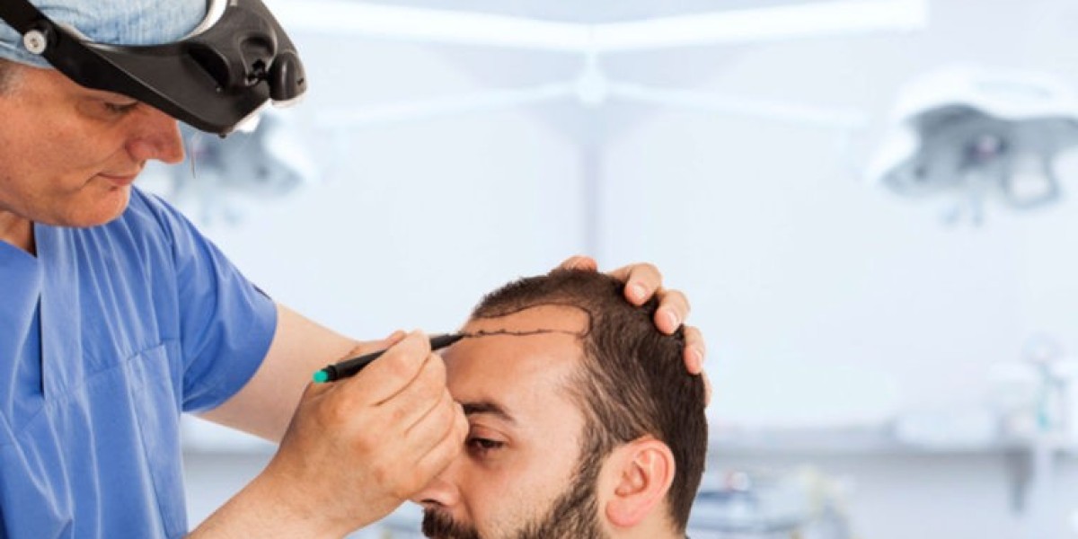 The Riyadh Gentleman’s Guide to Permanent Hair Restoration