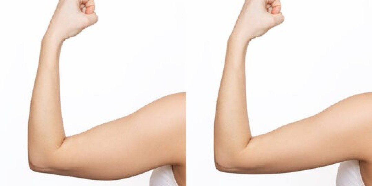 From Insecurity to Radiance: The Power of Arm Lift Surgery in Riyadh